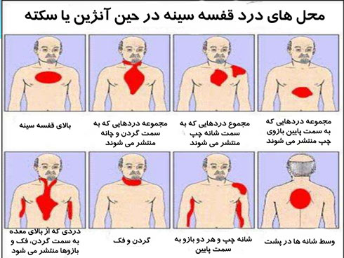 علائم سکته قلبی